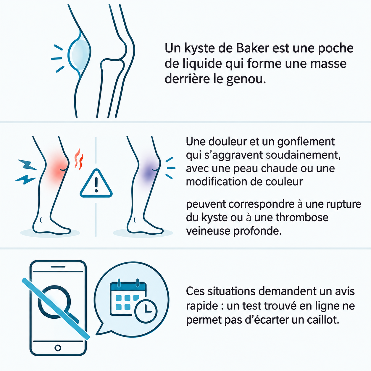Schéma illustratif : Un kyste de Baker est une poche de liquide qui forme une masse derrière le genou. ; Une douleur et un gonflement qui s’aggravent soudainement, avec une peau chaude ou une modification de couleur ; peuvent correspondre à une rupture du kyste ou à une thrombose veineuse profonde. ; Ces situations demandent un avis rapide : un test trouvé en ligne ne permet pas d’écarter un caillot.