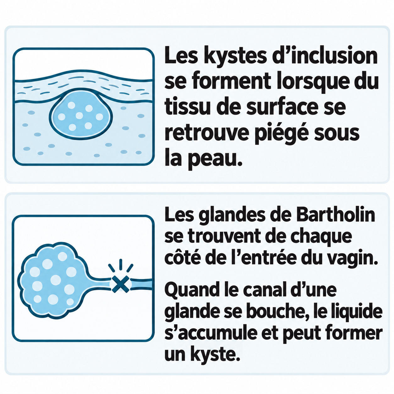 Schéma illustratif : Les kystes d’inclusion se forment lorsque du tissu de surface se retrouve piégé sous la peau. ; Les glandes de Bartholin se trouvent de chaque côté de l’entrée du vagin. ; Quand le canal d’une glande se bouche, le liquide s’accumule et peut former un kyste.